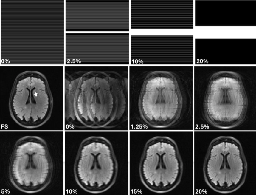 Modeling human observer performance with neural network observers in a forced localization task using undersampled MRI images